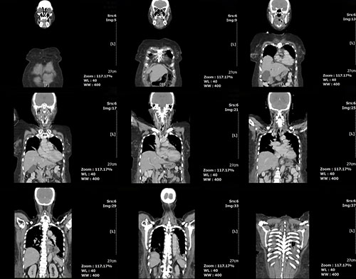 ct scan abdomen,chest and front view body by mri scan. medical radiology